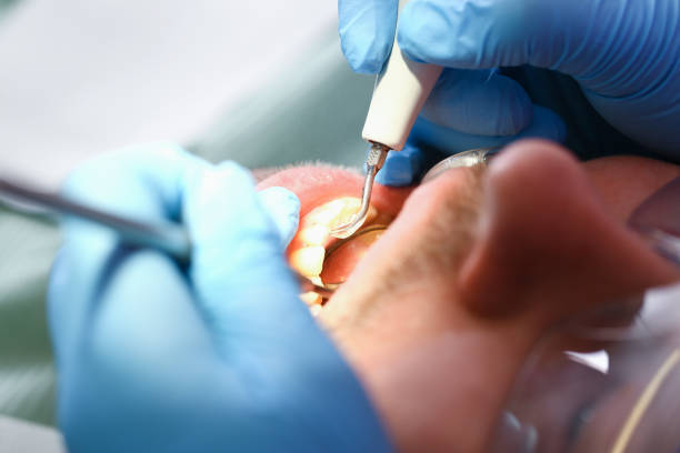 Emergency Dental Filling Replacement in PA
